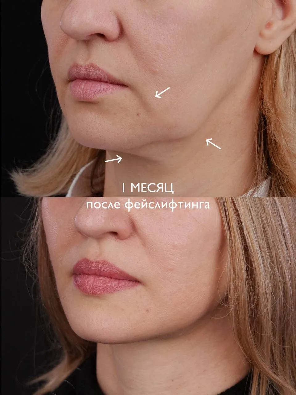 Преображение нижней трети лица 💚