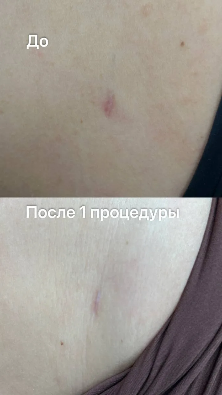 СО2 ЛАЗЕРНАЯ ШЛИФОВКА ШРАМОВ И РУБЦОВ