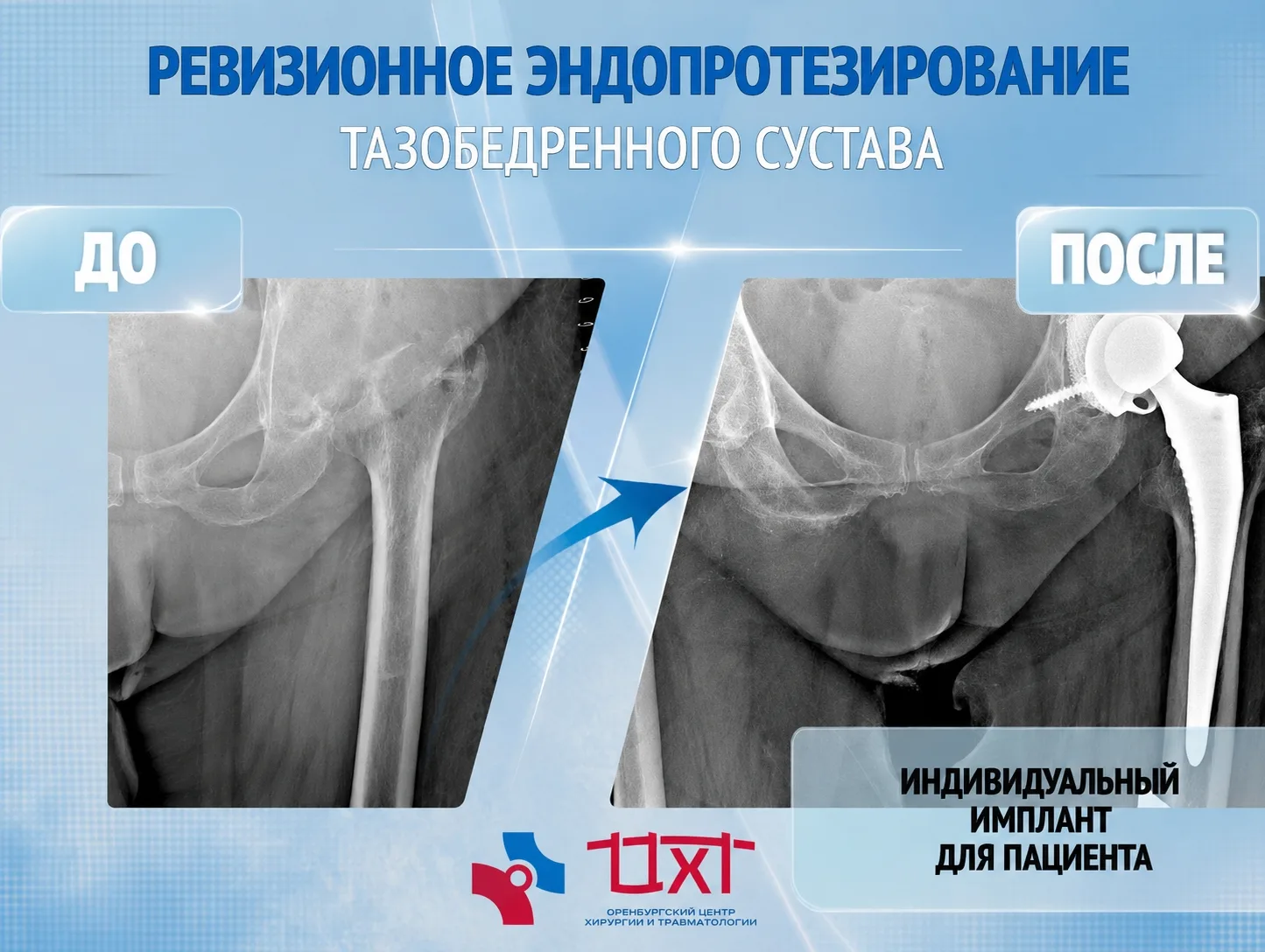 🔷 Пациент К. ранее перенёс протезирование левого тазобедренного сустава более 10 лет н...