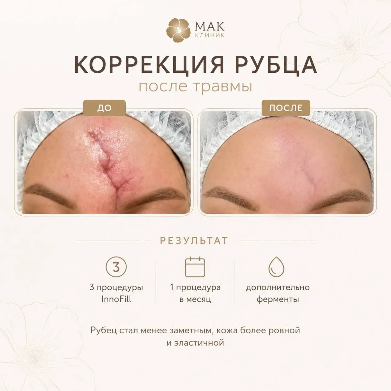 Коррекция рубца после аварии с помощью методики rf сепарации Иннофилл