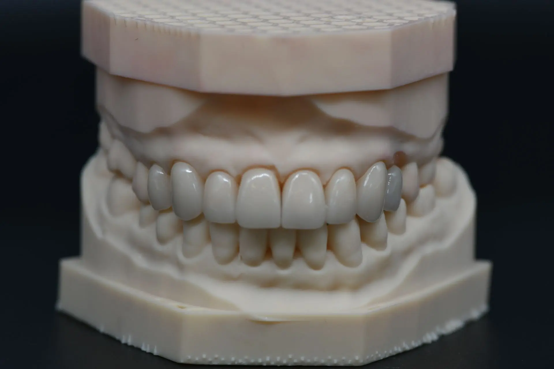 🦷 8 цельноциркониевых коронок: цифровой кейс от моделировки до готовой работы
