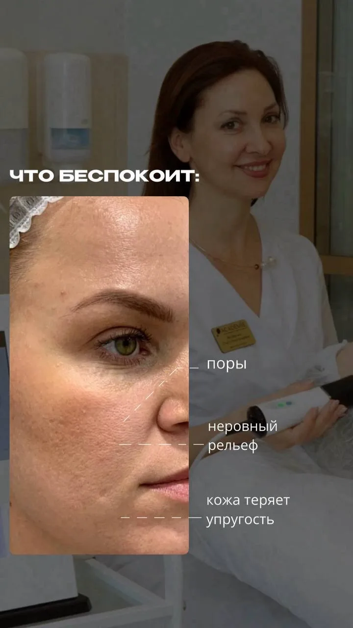 РОВНАЯ, ПЛОТНАЯ КОЖА

На фото - результат работы на аппарате INUS.
Иглчатый RF нового поколения, кот