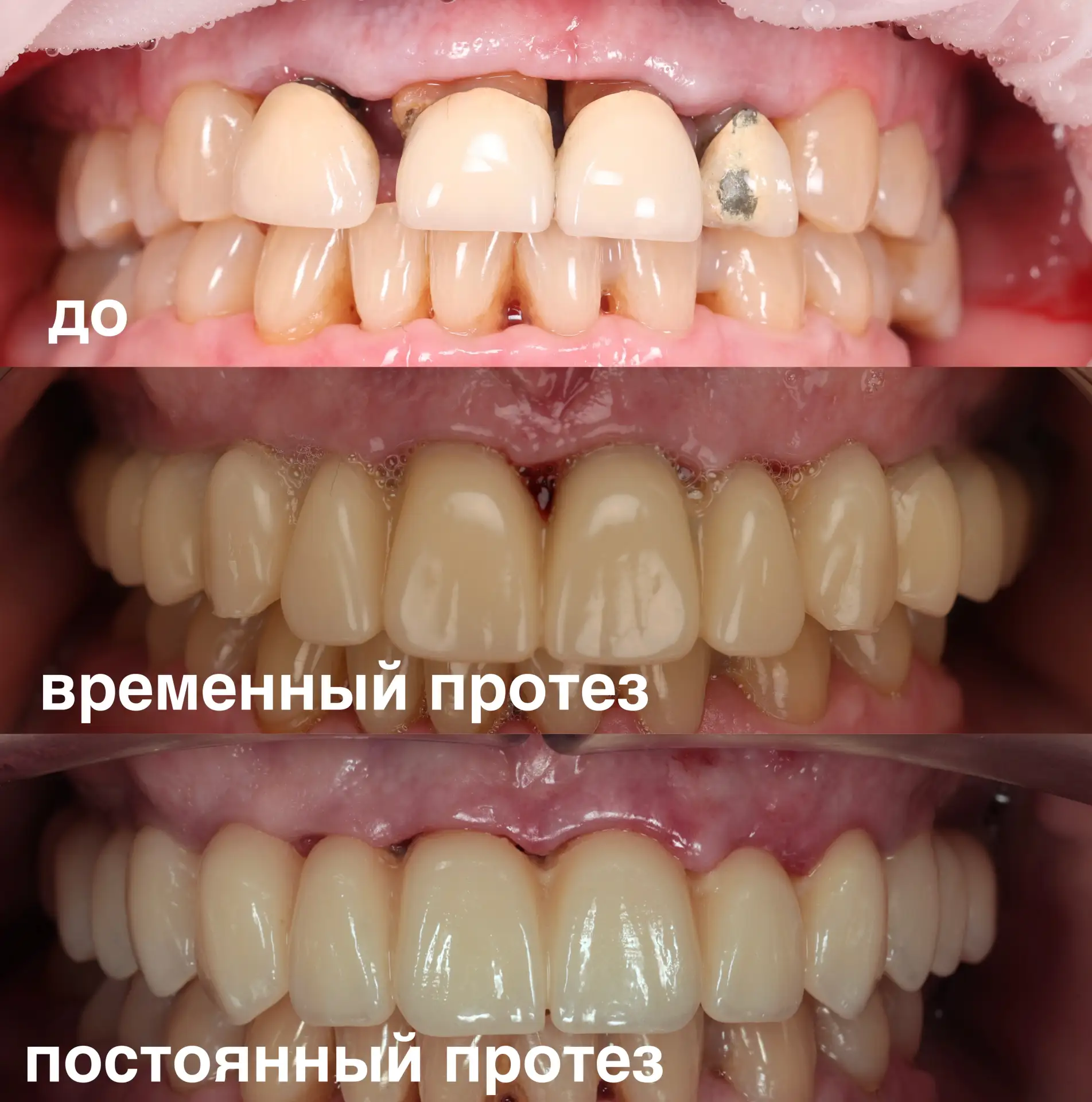 Тотальная работа на 8 имплантатах на верхней челюсти.
Натуралистичность - то, что всегда в приоритет