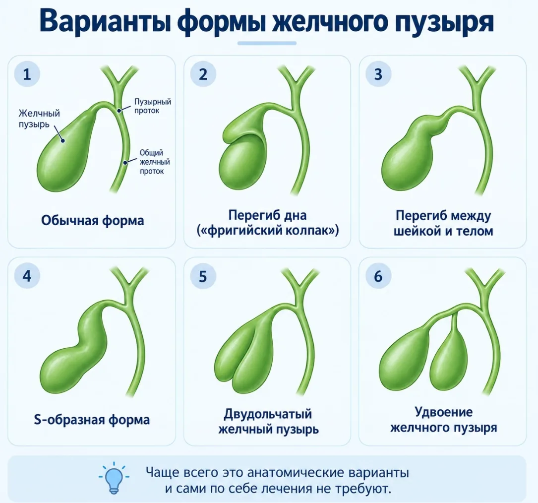 Находка, которая встречается на УЗИ «Перегиб желчного пузыря».