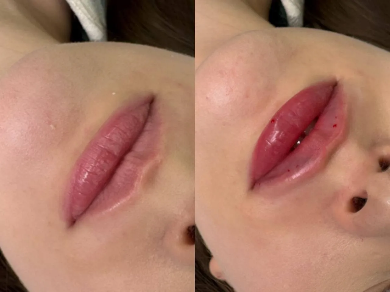 Почему после губ бывает асимметрия?👄
