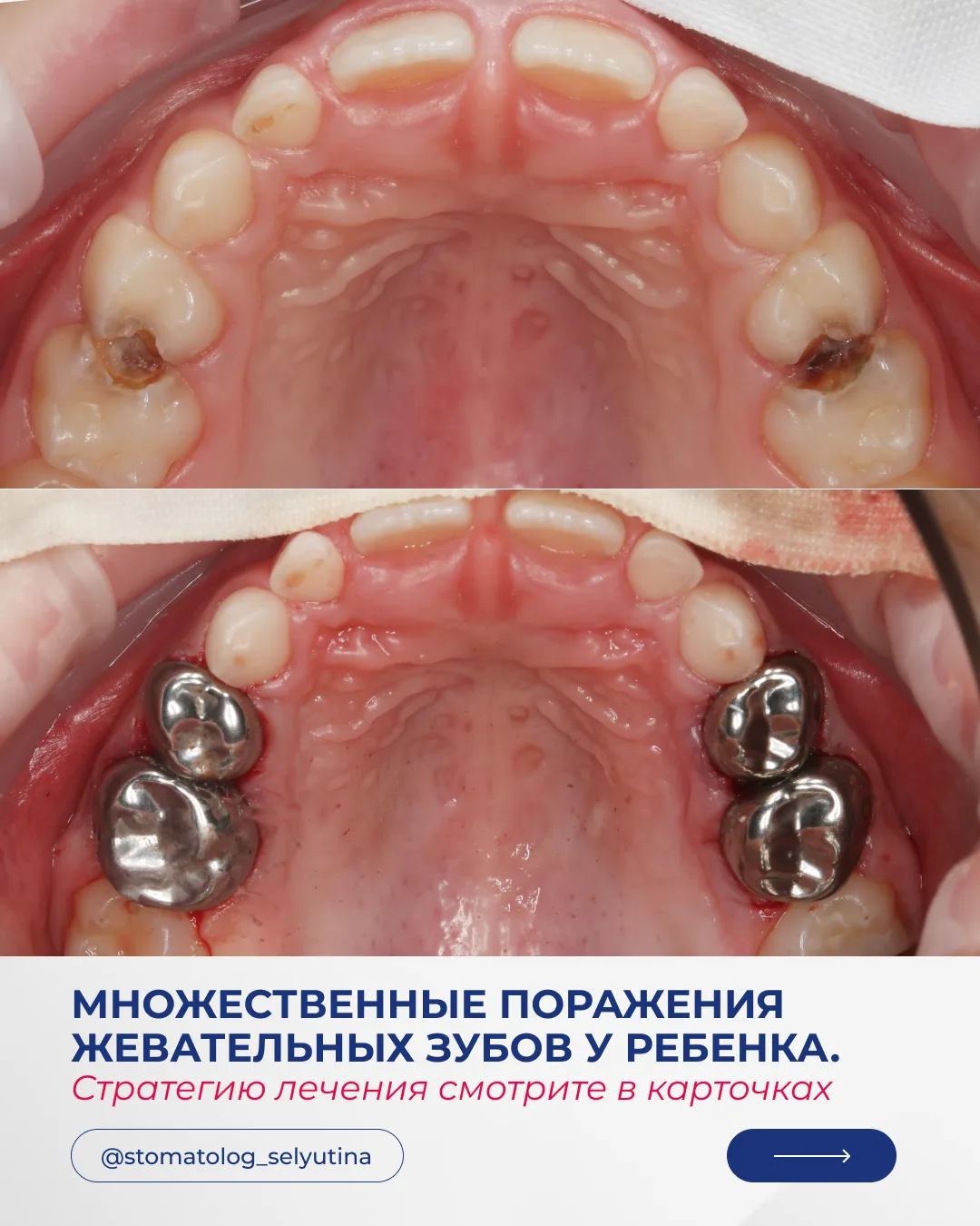 К нам в Центр стоматологии обратились родители с ребенком пяти лет.