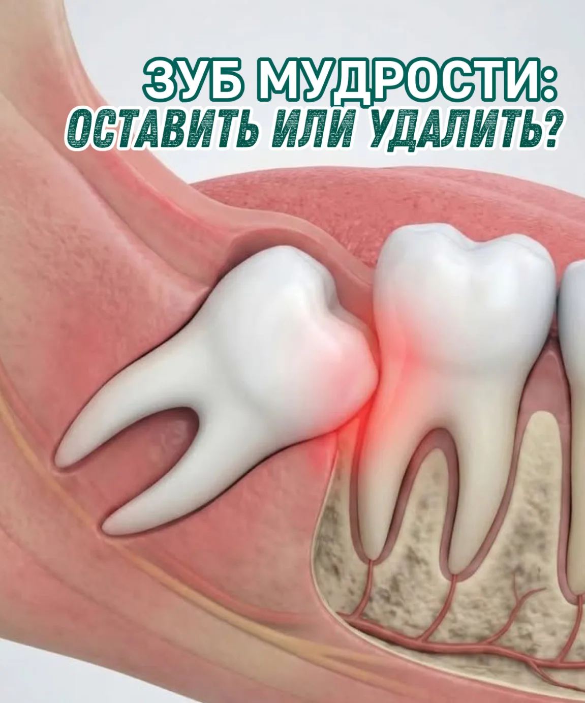 Нужно ли удалять зуб мудрости, если он НЕ болит?