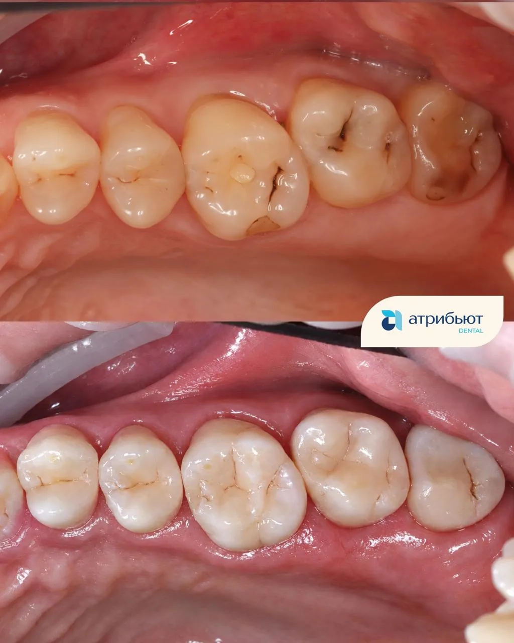 🦷 Анатомическая точность: обновление старых пломб
