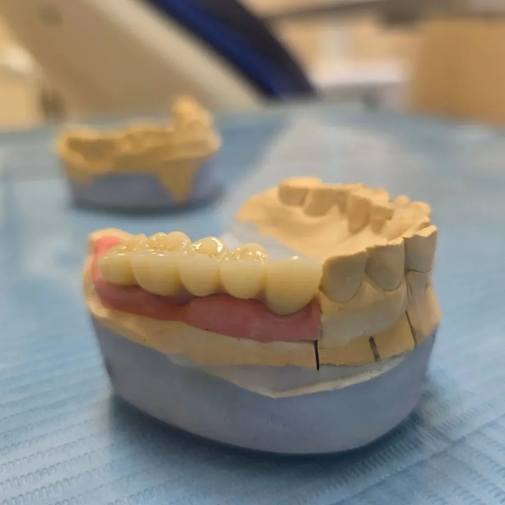 Сдали цельноциркониевый мост на имплантах! 🔥🦷