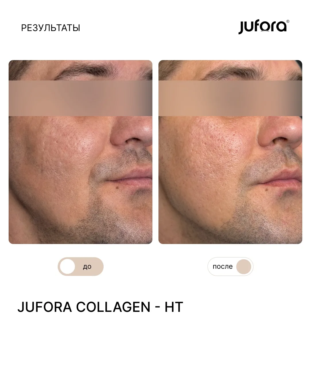 💉 Делимся результатами проведения процедуры коллагенотерапии JUFORA COLLAGEN - HT