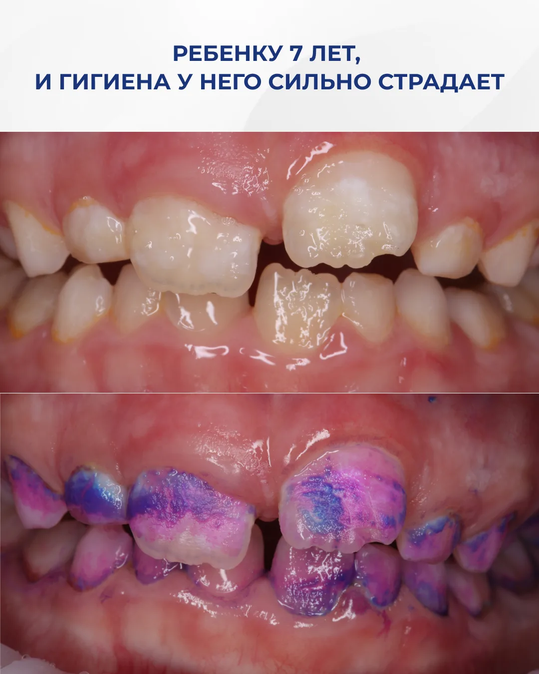 Недостаточно тщательная домашняя гигиена может привести к множественному поражению зубов. Именно это