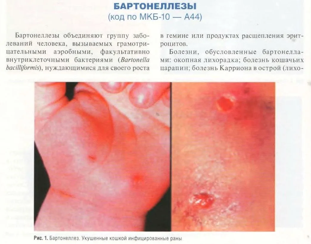 Бартонеллезы