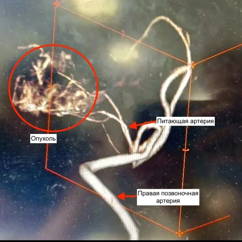 ⚡🤕 Сильная головная боль оказалась редкой опухолью: как врачи Александровской больницы спасли пацие
