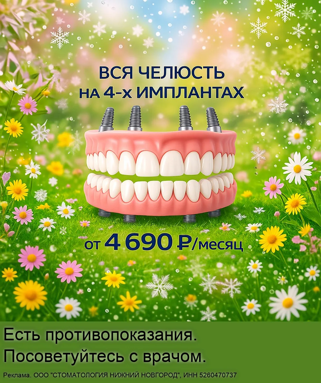 Несъёмное протезирование на 4-х имплантах в Н.Новгороде.