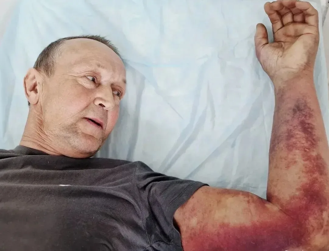 🙏Мужчина чуть не умер, собирая крапиву в Челнах. Его привезли в больницу с укусом гадюки и отёком Кв