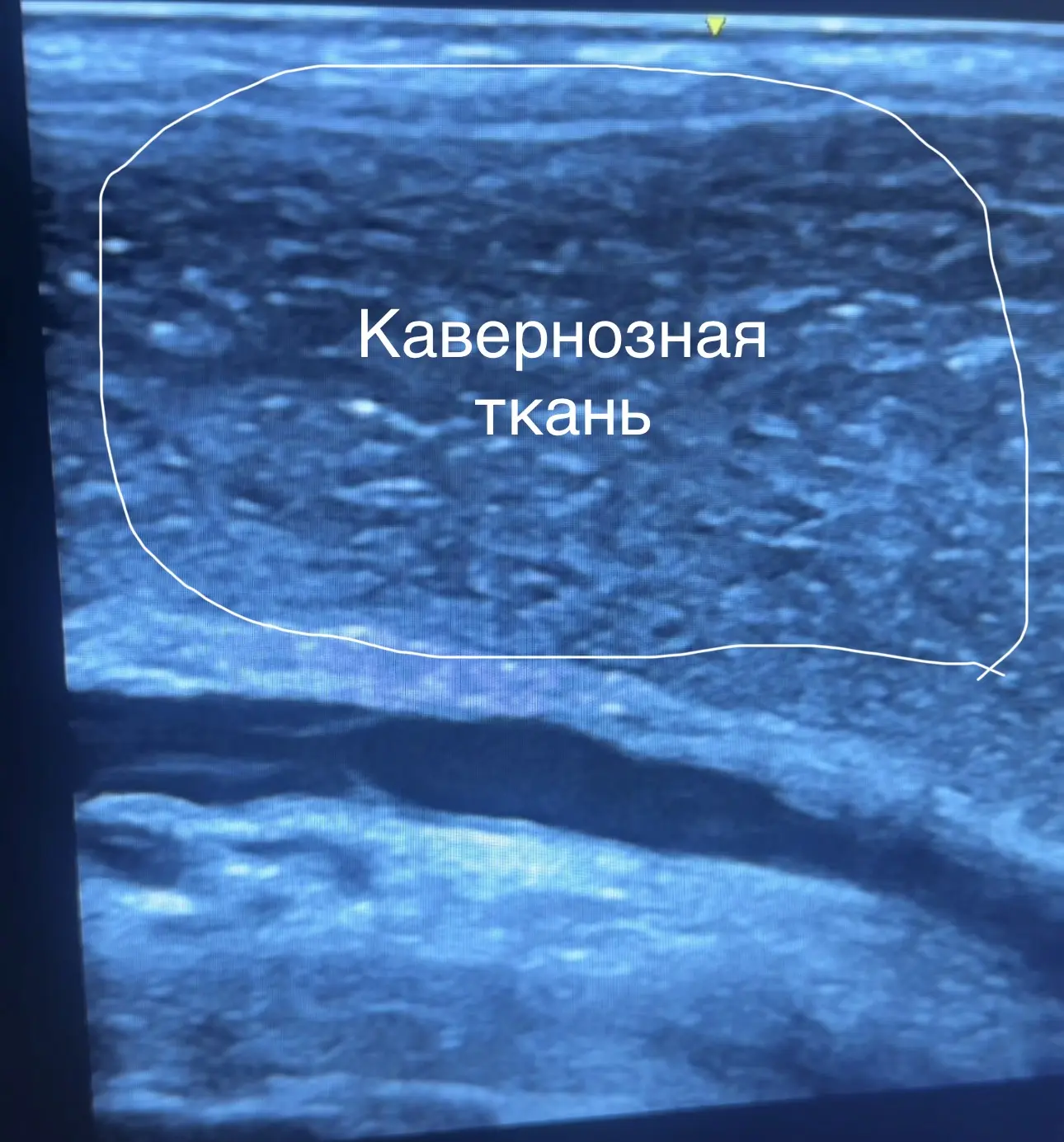 Всем доброе утро! 

Давайте я расскажу, что за исследование я показал вчера. Это УЗДГ полового члена