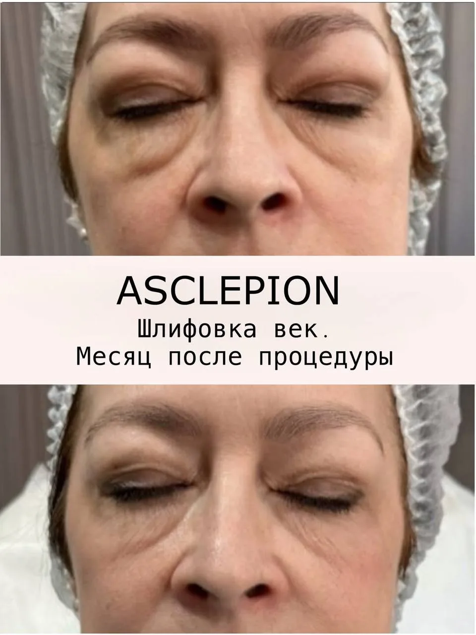 Лазерная шлифовка век