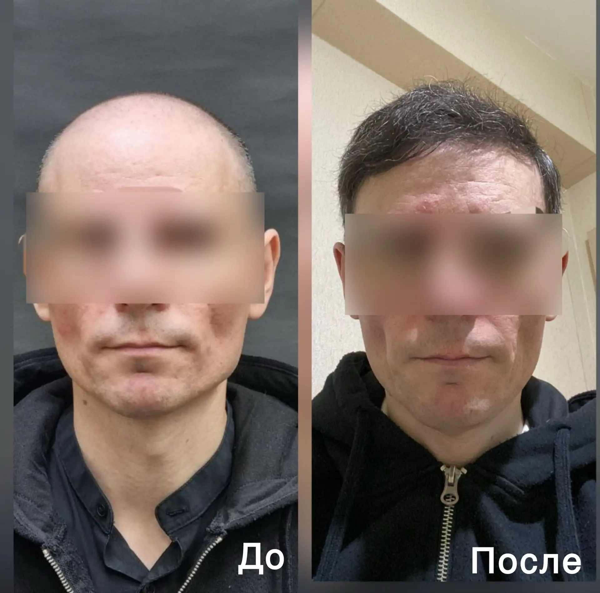Сегодня показываем результат пересадки волос   у пациента с выраженной андрогенной алопеции ( 6 тип 