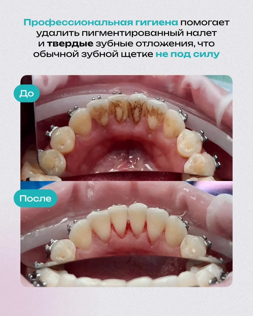 Профессиональная гигиена – обязательная процедура, которую необходимо делать минимум 1 ...