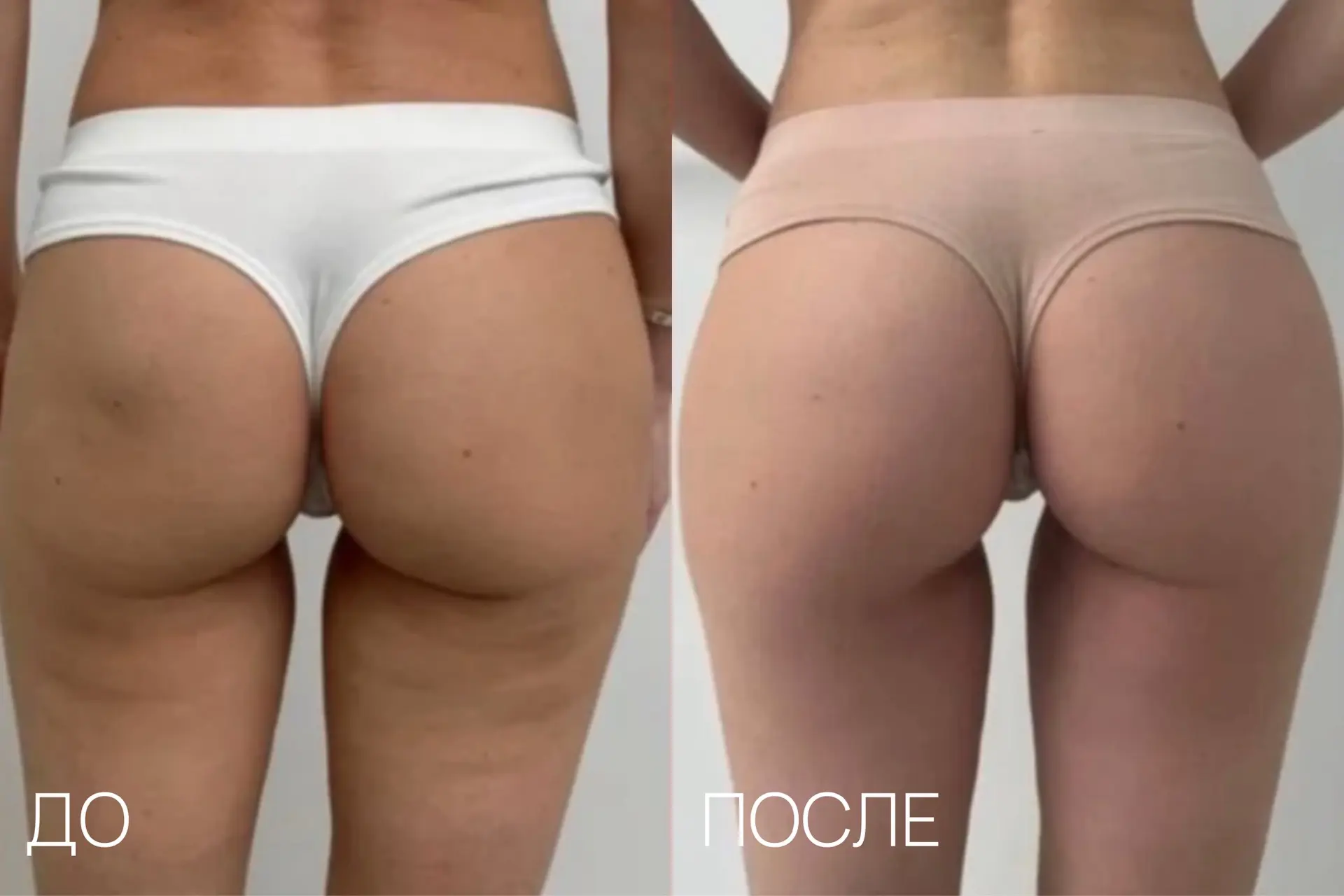 Нет волшебной таблетки для стройности… но есть такая процедура! ✨