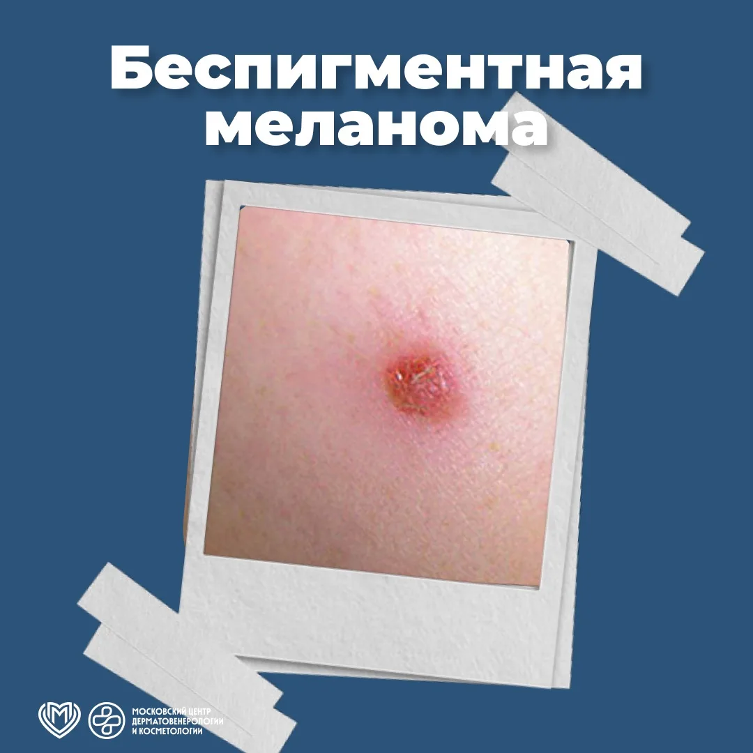 🔘 Когда речь идет о меланоме, наши пациенты обычно представляют себе новообразование я...