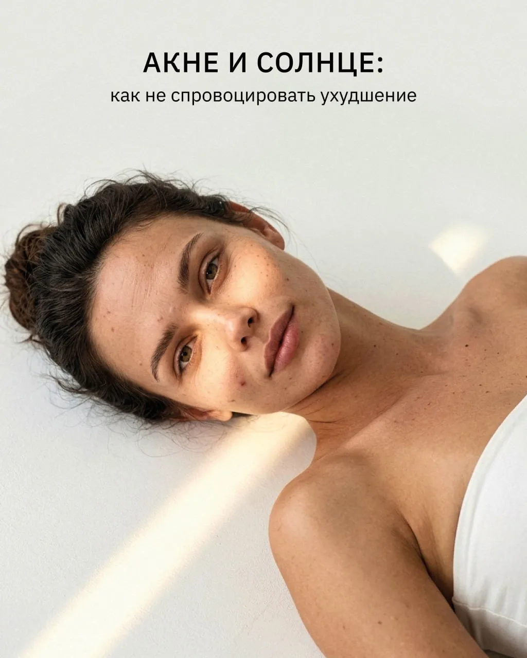Солнце при акне часто воспринимается как позитивный фактор, но это временный эффект.