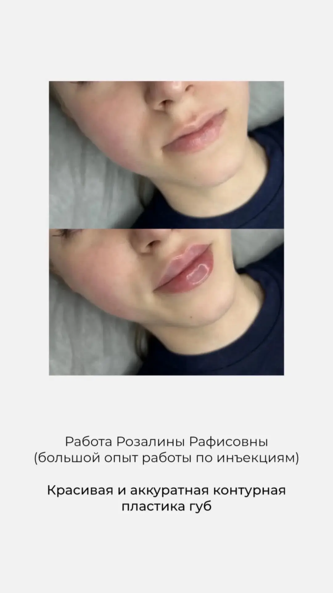 У косметолога Розалины можно сделать контурную пластику губ всего за 10900 😍