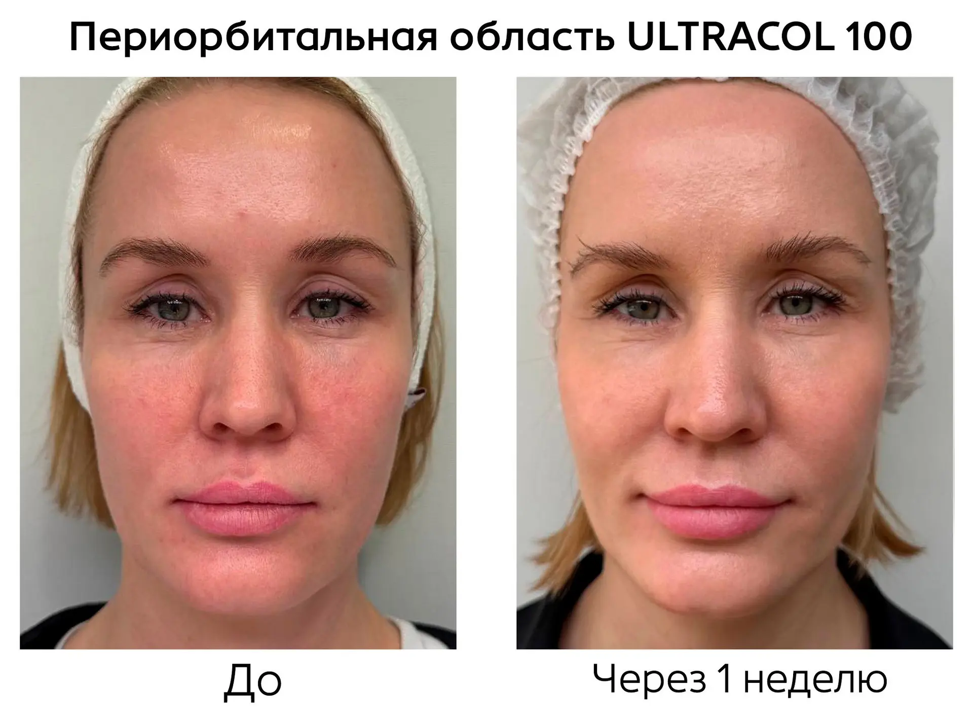 Периорбитальная область — зона, где особенно важен выбор препарата и ожидаемый характер...