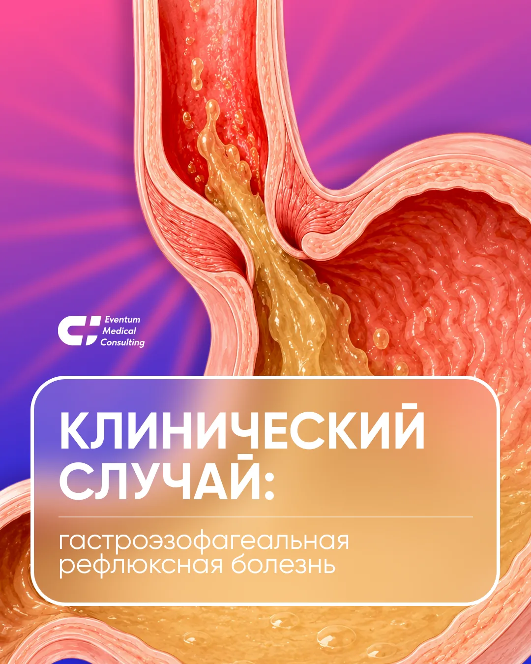 📝 Клинический случай: гастроэзофагеальная рефлюксная болезнь