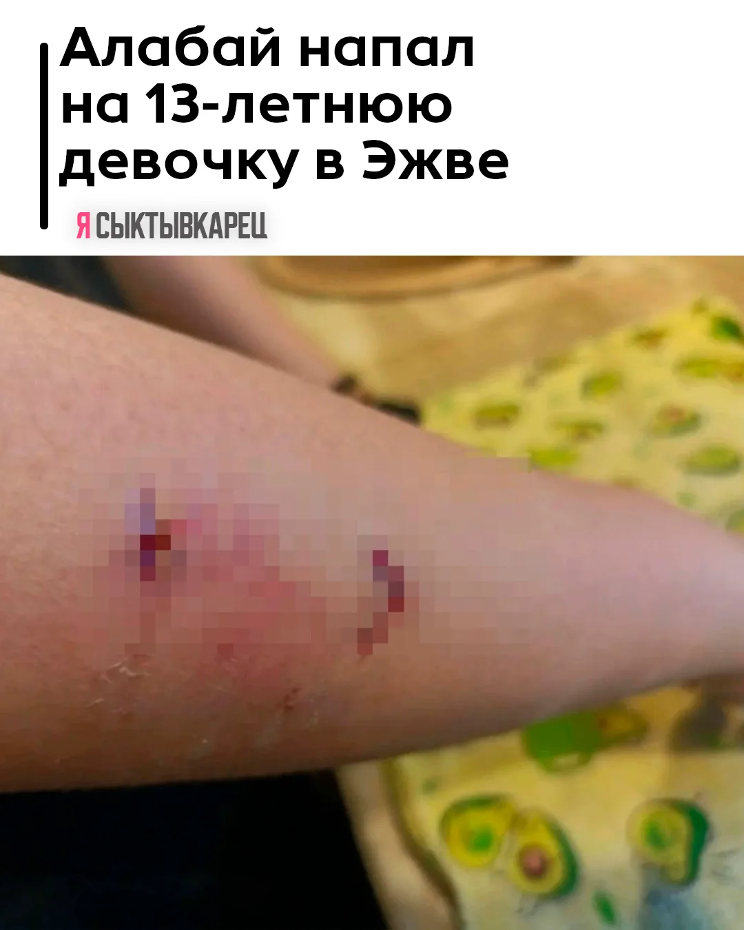 Алабай напал на 13-летнюю девочку в Эжве: ребёнка госпитализировали.