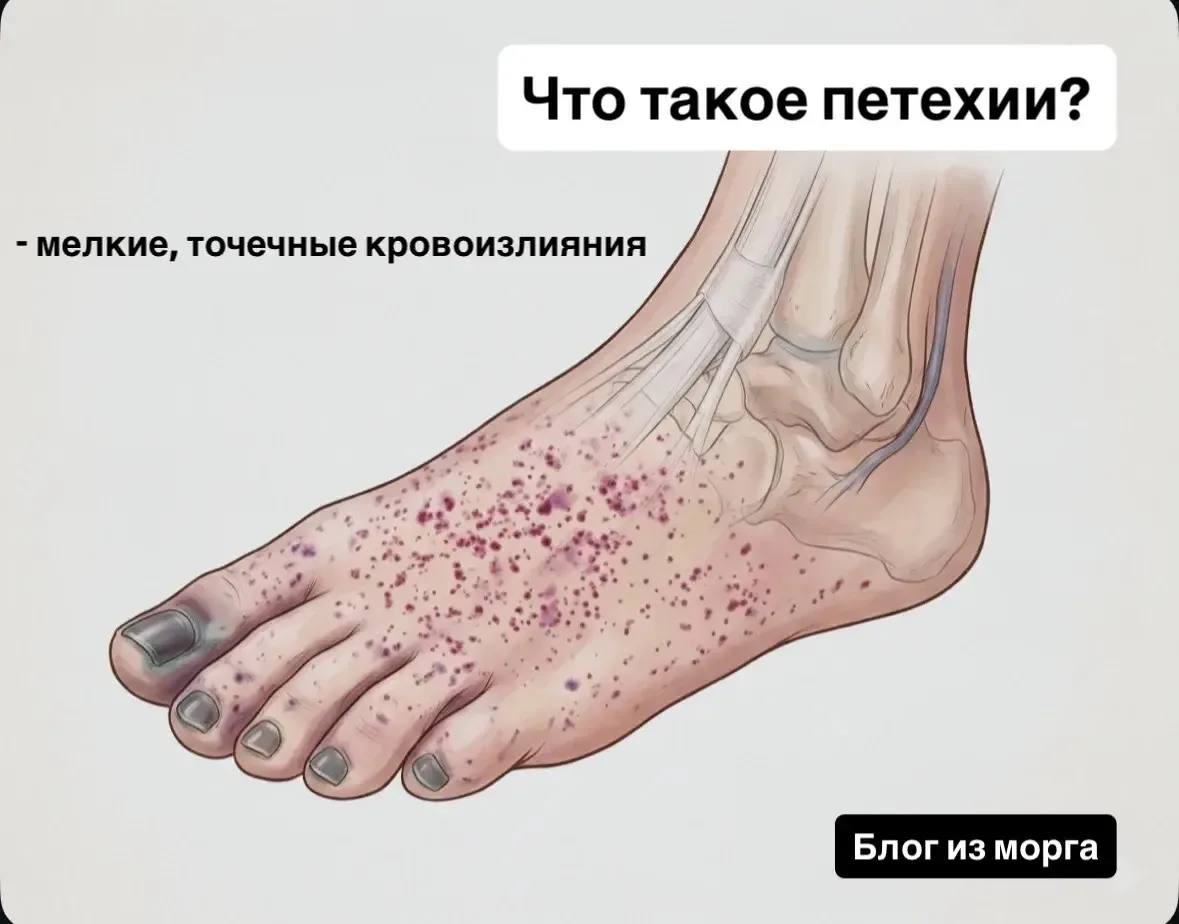 Разберем, что такое петехии - признак, который сигнализирует нам о том, что смерть наст...