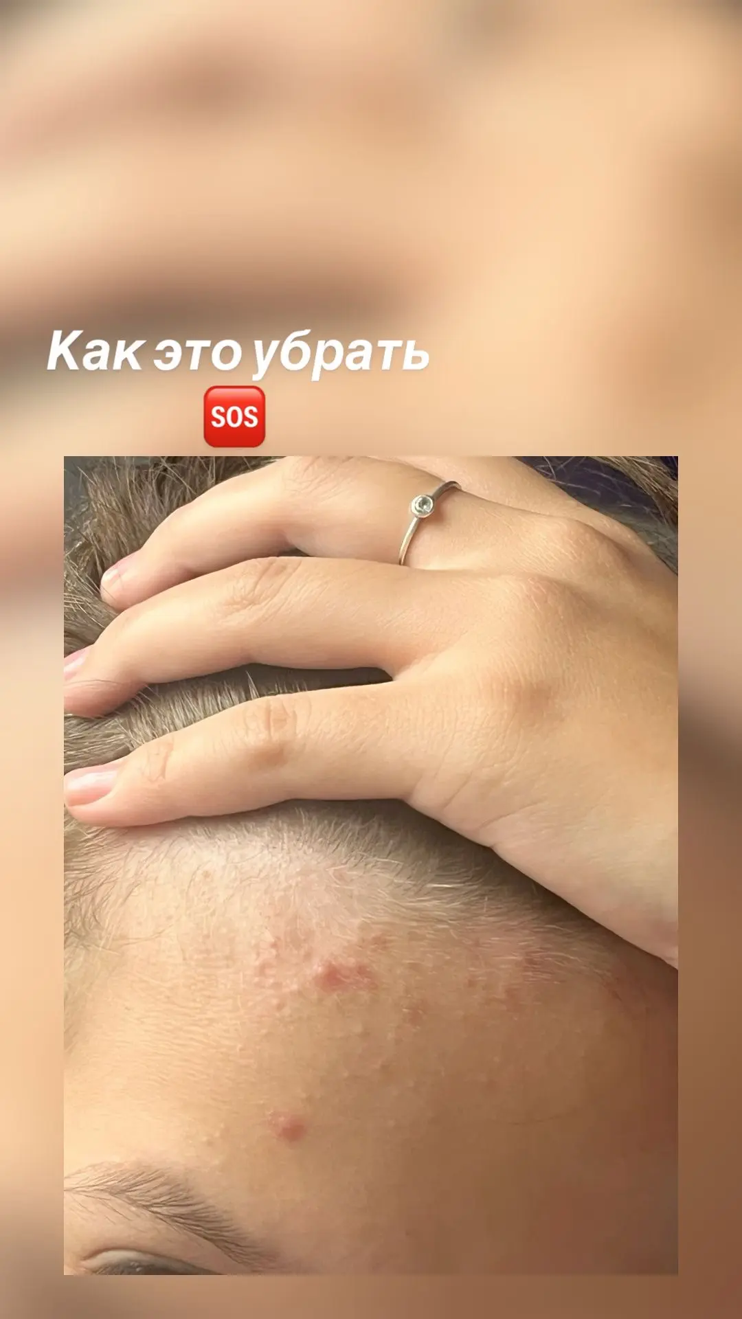МЕЛКИЕ ПРЫЩИКИ НА ЛБУ — В ЧЁМ ПРИЧИНА?