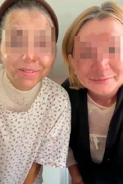 Взорвавшаяся скороварка сожгла почти четверть тела двум девушкам.