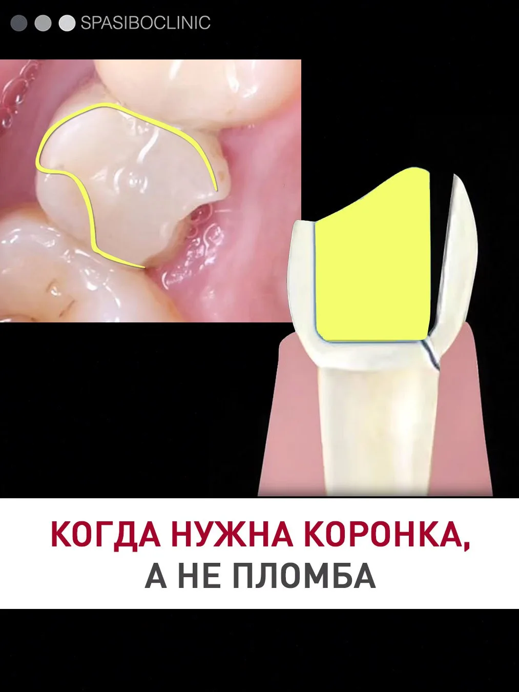Врач говорит пациенту: мы сейчас вылечим кариес, но затем нужно ставить коронку, стенки...