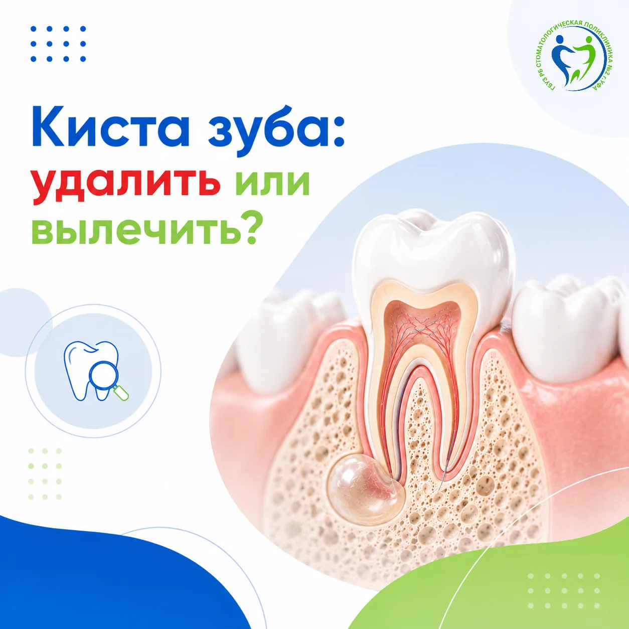 Обнаружили кисту у корня зуба — обязательно ли удалять зуб? Не всегда.
