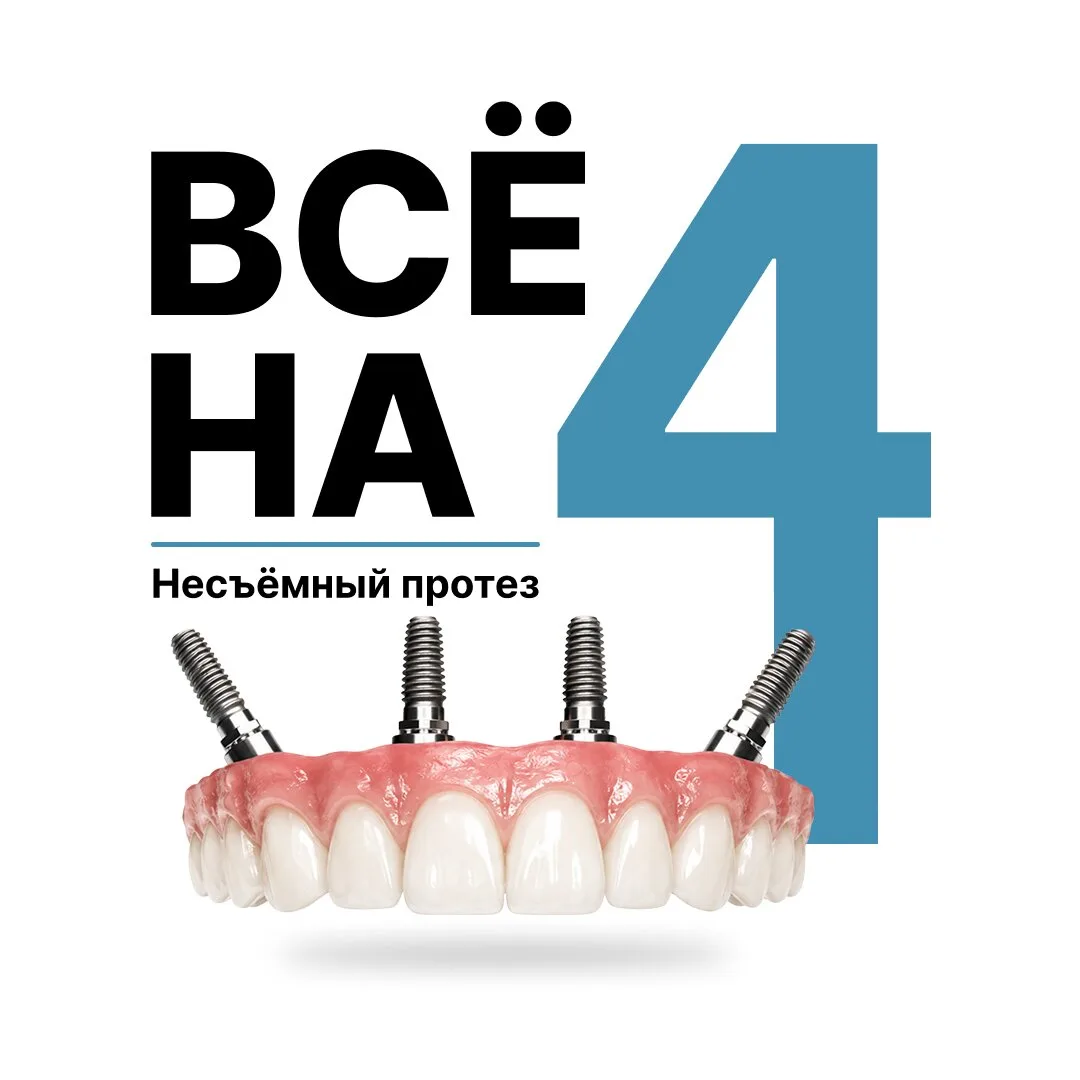Несъёмный протез на 4-х имплантах в «Монтрё». Воронеж