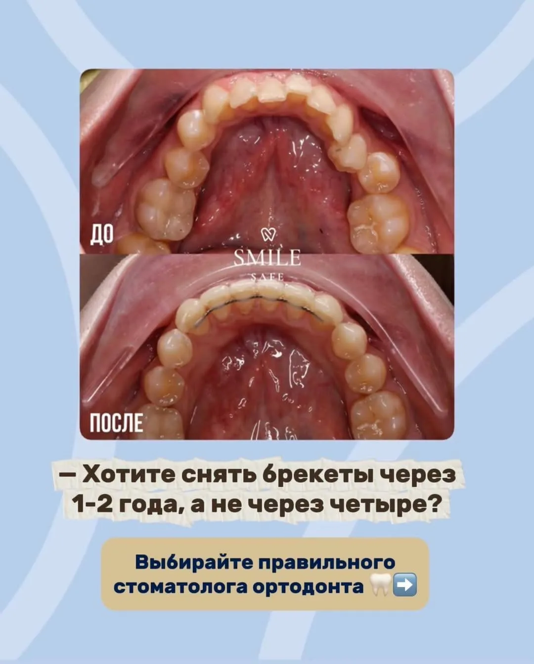 7 пунктов, которые спасут вас от лишних лет в брекетах❗️❗️