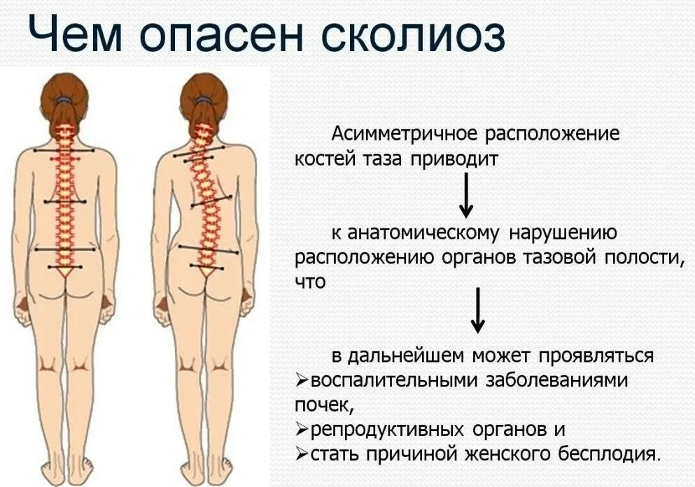 Проверяем ребенка на сколиоз.
