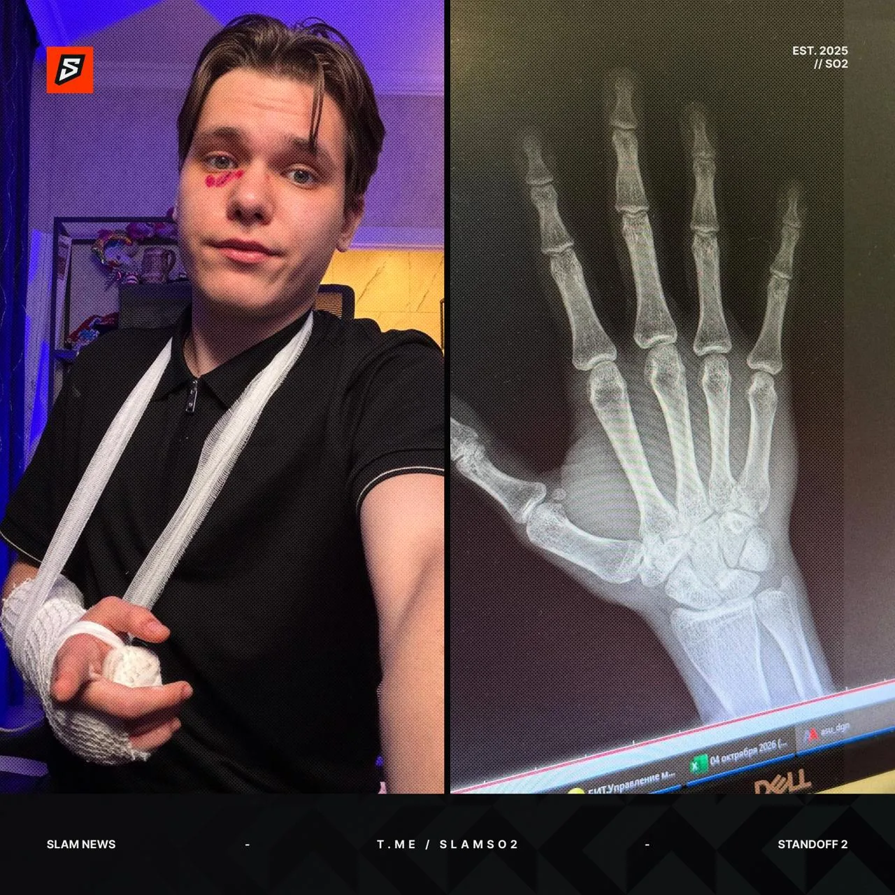 ❗️ GENTLEMAN СЕГОДНЯ БУДЕТ ИГРАТЬ С ПЕРЕЛОМОМ РУКИ
