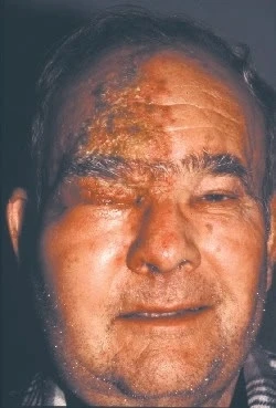 ПОСТГЕРПЕТИЧЕСКАЯ НЕВРАЛГИЯ ТРОЙНИЧНОГО НЕРВА: ЛИНИИ ТЕРАПИИ