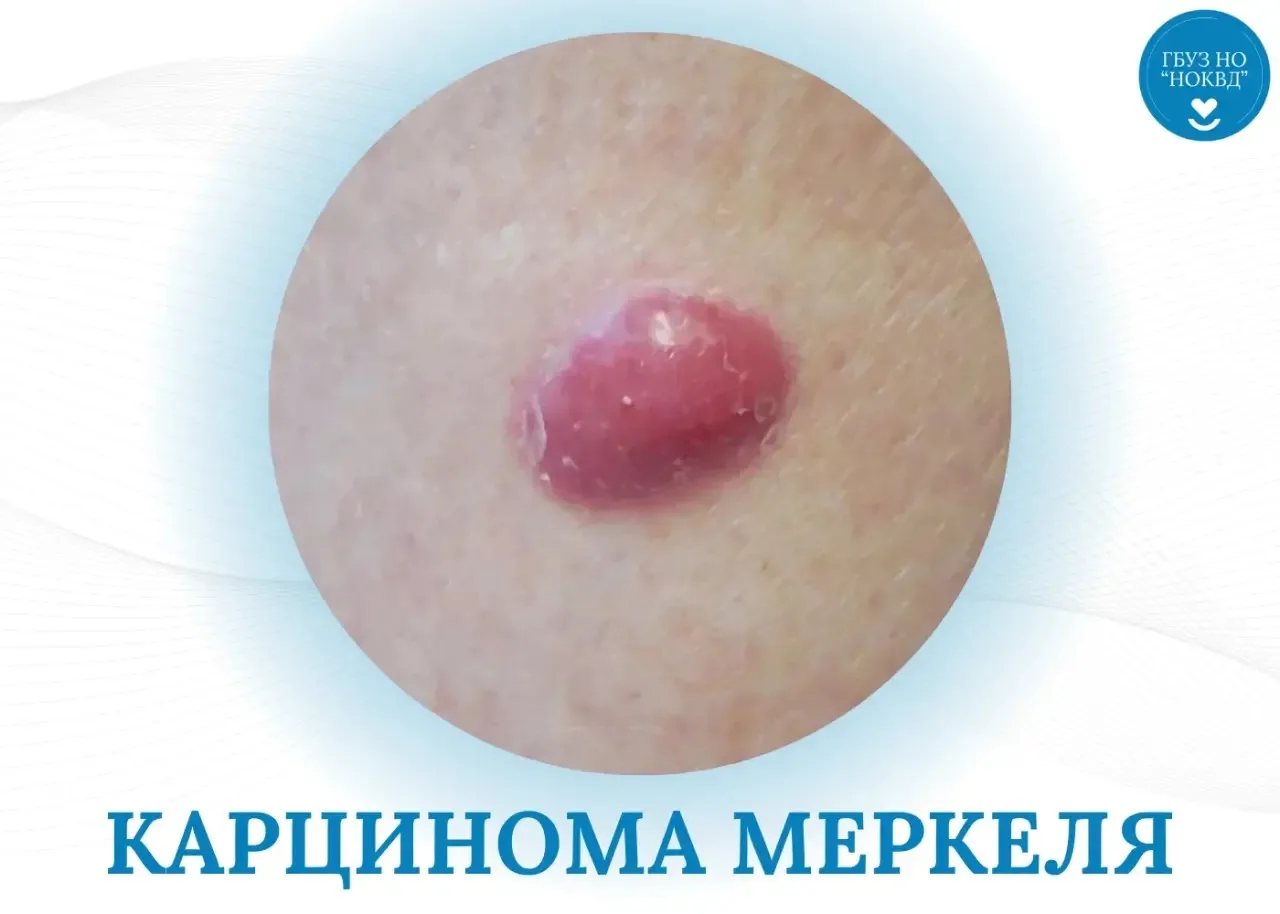Что такое карцинома Меркеля и почему важно не пропустить её?