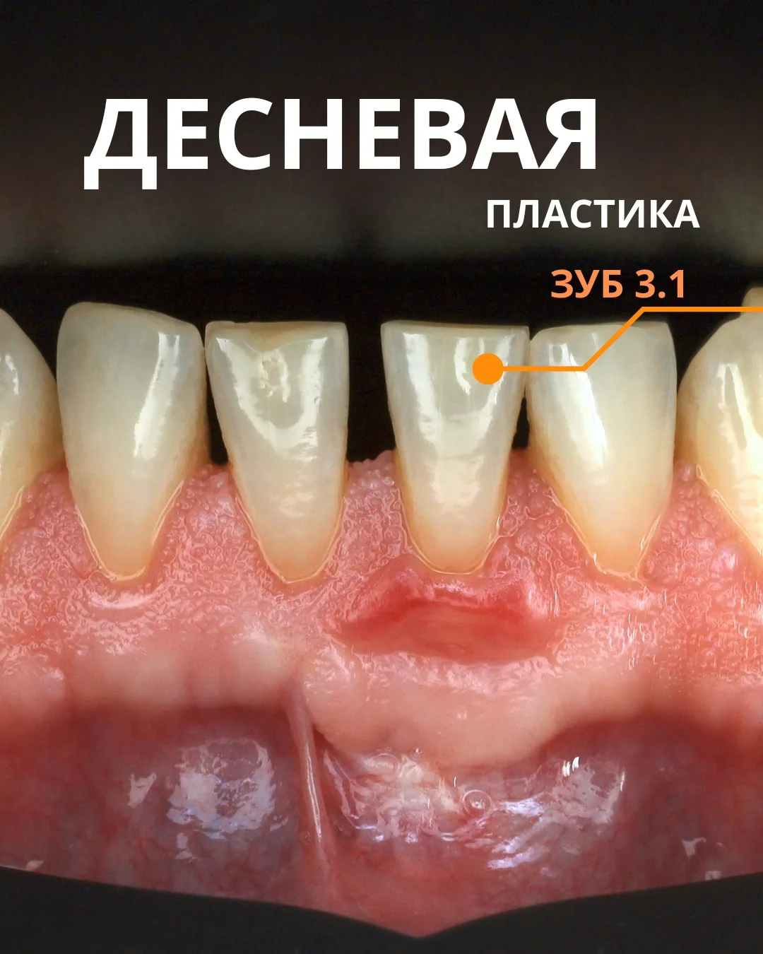 Пациент обратился с жалобами на эстетику (оголение корня) и чувствительность от кислого...