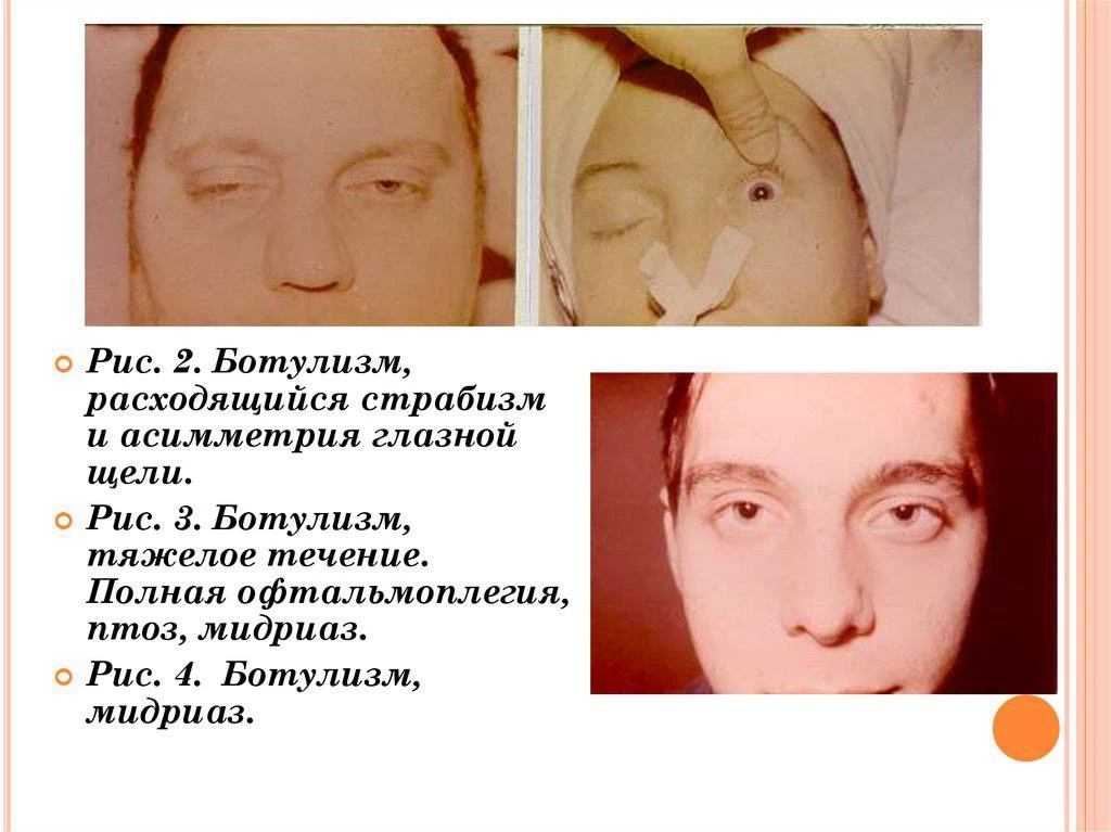Симптомы, которые нельзя игнорировать!
Заболевание начинается не с расстройства желудка! Тошнота и р
