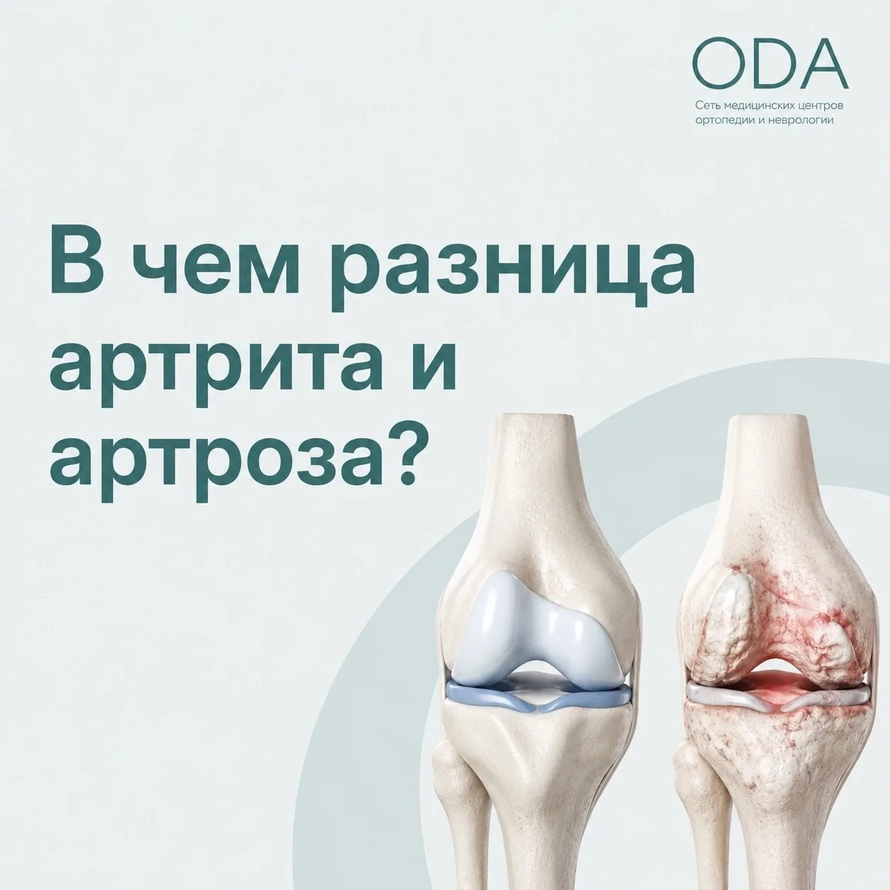 ❗ Артрит или артроз? Многие путают эти диагнозы, а разница существенная.