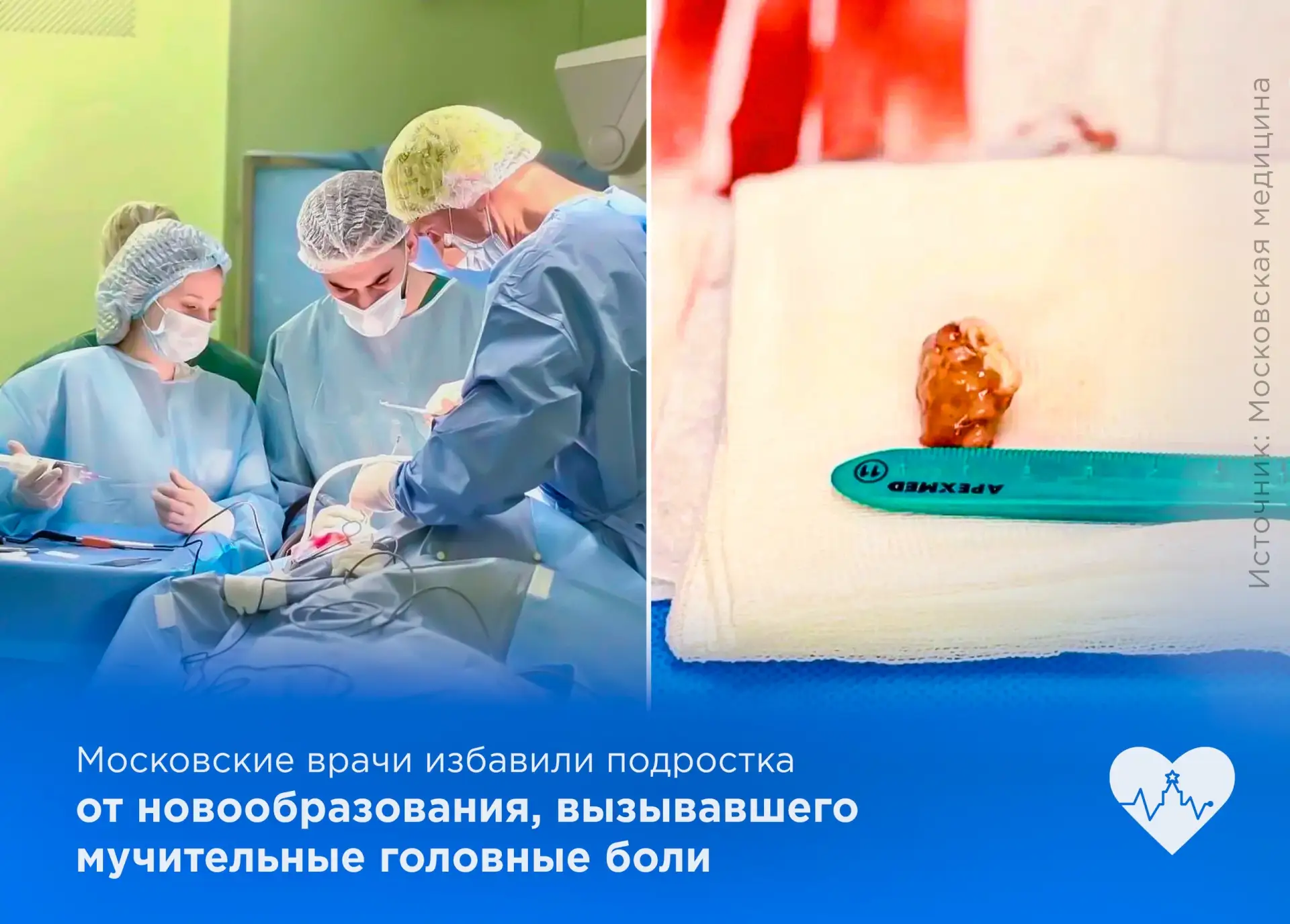 Московские врачи избавили подростка от новообразования, вызывавшего мучительные головны...