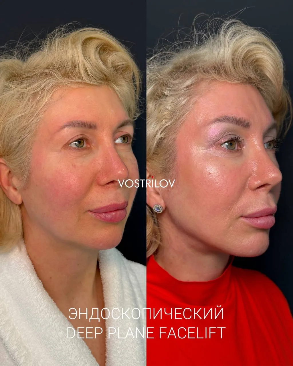 В начале июня мы выполнили гибридный лифтинг лица Endo Deep plane face lift моей шикарн...