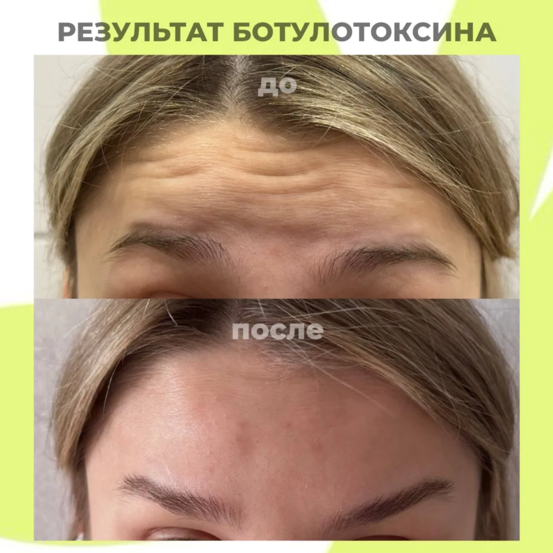 На фото - результат нашей работы после процедуры ботулотоксина 🤍