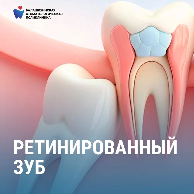 Ретинированный зуб: что это и чем опасен? 🦷