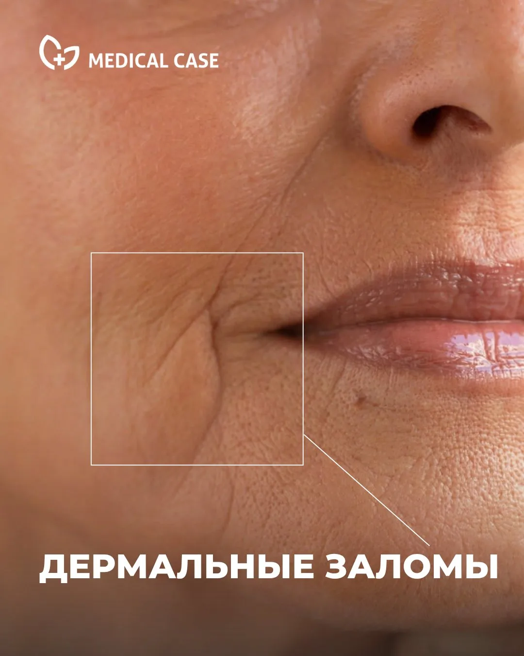 🔥 Глубокие морщины и потеря объема? Иногда одной процедуры достаточно, чтобы увидеть з...