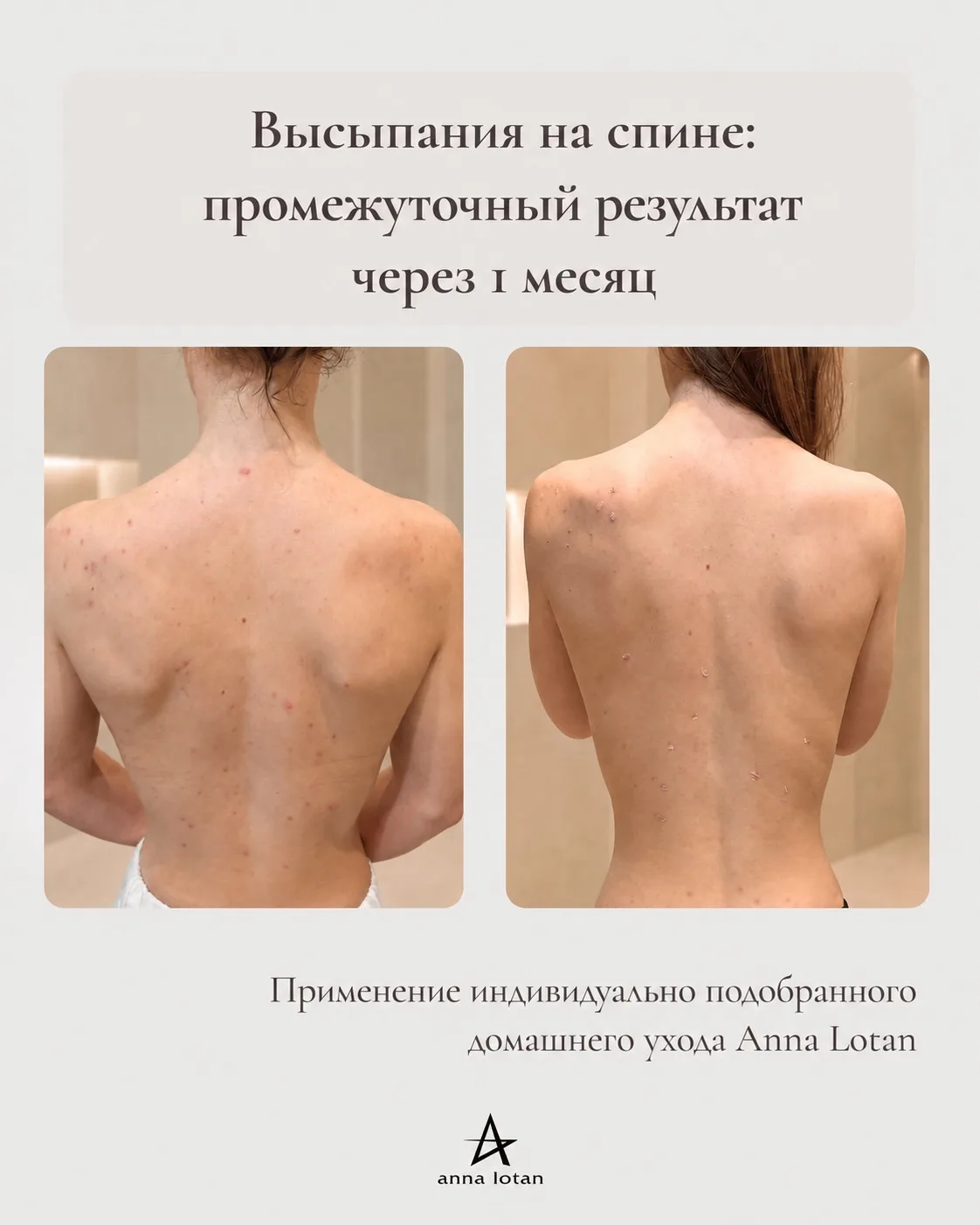 ❗Акне на спине: промежуточный результат через 1 месяц домашнего ухода Anna Lotan без дополнительных 